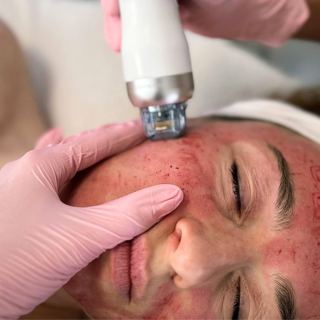 Lézeres szőrtelenítés & arckezelések – Bliss Laser & Beauty Budapest
