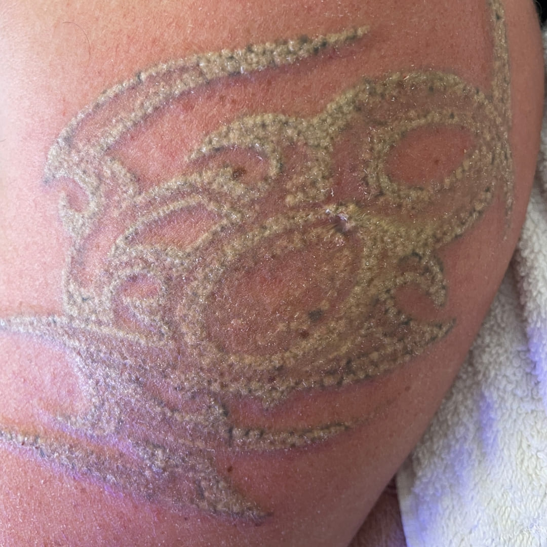 Lézeres szőrtelenítés & arckezelések – Bliss Laser & Beauty Budapest